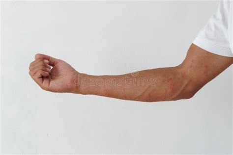 Rash Rashes Caused By Allergic Reactions On Arms Stock Photo Image