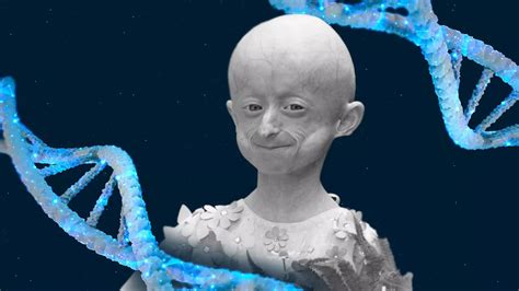 Progeria Causes Symptoms Diagnosis And Treatment