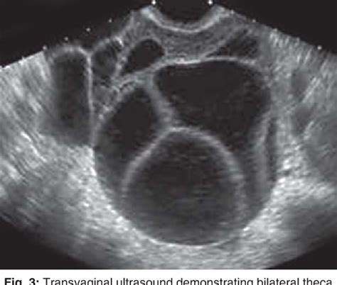 Figure 3 From Ultrasound Imaging Of Gestational Trophoblastic Disease
