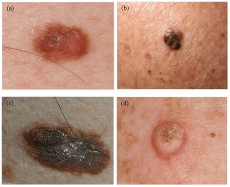 Four Examples Of Skin Lesions A Dysplastic Nevus B Seborrheic