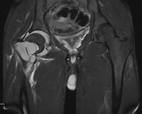 Femoral Neck Aneurysmal Bone Cyst Sumers Radiology Blog