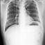 Benign Lung Nodules Identified Using Proteomic Biomarker
