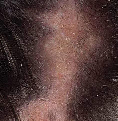 What Are The Causes Of Hair Loss Red Scalp Bumps Bloo