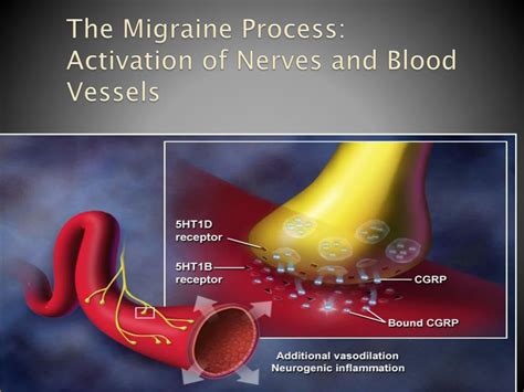 Ppt New Trends In Headache And Migraine Treatment Powerpoint