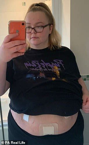 Woman Who Weighed 27 Stone Pays £9000 For Gastric Band Surgery I