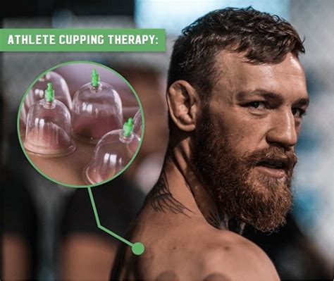 What Is Cupping Therapy And What Are The Benefits Glasgow Premier Physiotherapy