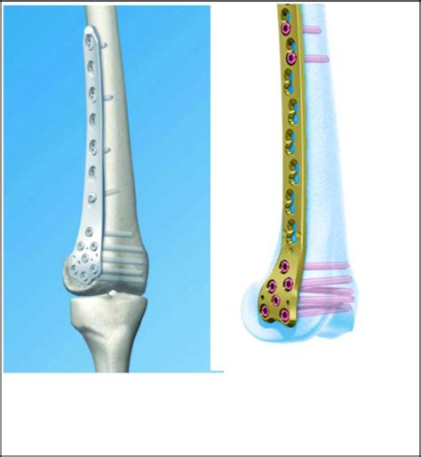 Distal Femur Ao Type A Fractures Surgical Options Techniques