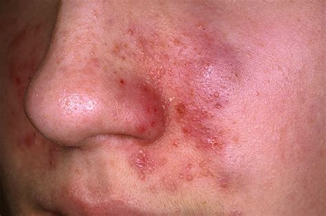 Seborrheic Dermatitis Pictures Treatment Home Remedies Symptoms