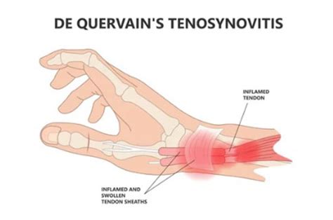De Quervain Tenosynovitis Surgery Midwest Orthopaedics