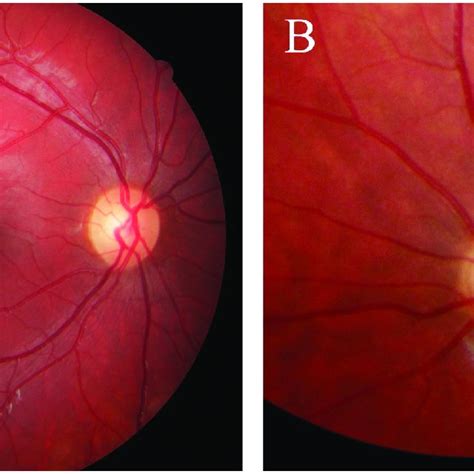 Fundus Photographs From Case 14 With Bilateral Optic Nerve Hypoplasia