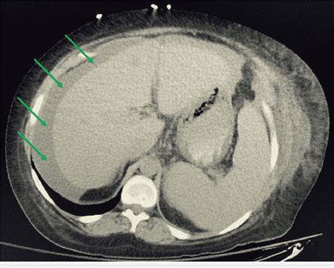 Representative Ct Image Of The Abdomen Showing Ascites Green Arrows