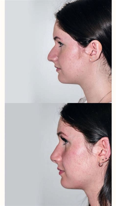 La rhinoplastie chirurgie esthétique nasale consiste à enlever lexcédent de cartilage nasal