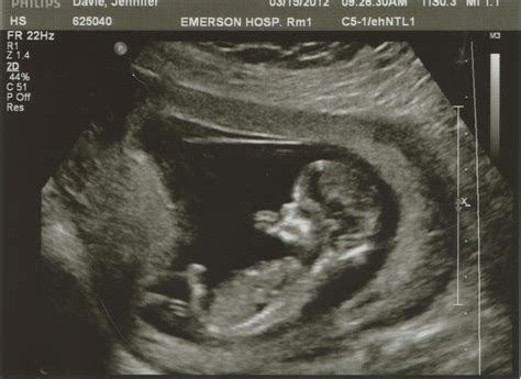 Little Baby Davie 12 Weeks End Of The First Trimester March 15 21