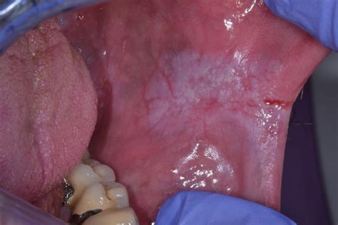Oral Leukoplakia OPMDCARE