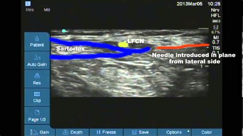 Ultrasound Guided Lateral Femoral Cutaneous Nerve Of Thigh Block Youtube