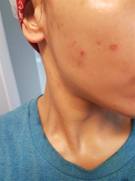 Epuris Month 2 My Skin Is Worse Than Ever Accutane Isotretinoin Logs Forum