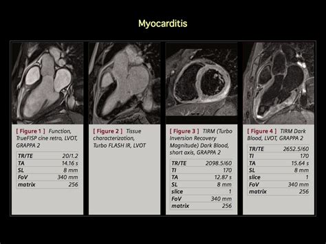 Acute myocarditis is one of the most challenging diagnosis in cardiology. Keywords: Eosinophilic Myocarditis, Ischemic ...