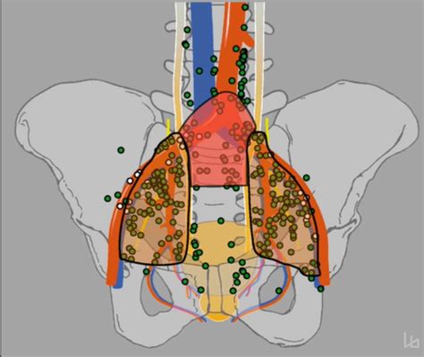 Standardized And Simplified Robot Assisted Superextended Pelvic Lymph