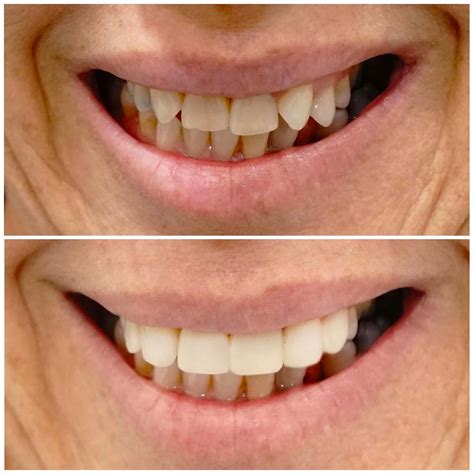 Composite Veneers Brisbane Free Consults Available Smiling Dental