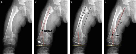 Acute Deformity Correction Using An Osteotomy Springerlink