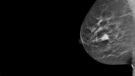 Breast Microbiome Profiles Linked To Higher—or Lower—chance Of Cancer