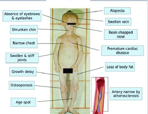 Sign And Symptoms Of Progeria Download Scientific Diagram
