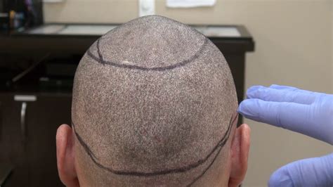 Fue Donor Scar From Hair Transplant Surgery Fue By Dr Diep San