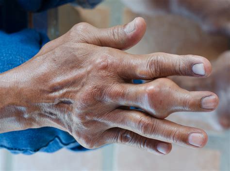 La Artritis Gotosa Puede Provocar Deformidad En Las Articulaciones