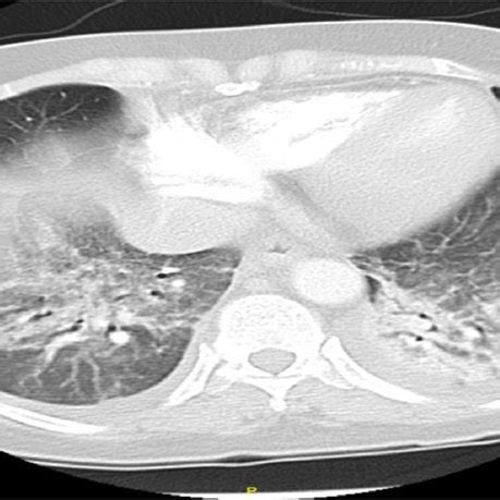 A Chest Ct Scan Showing Right Upper Lobe Mass With Hilar Lymph Node