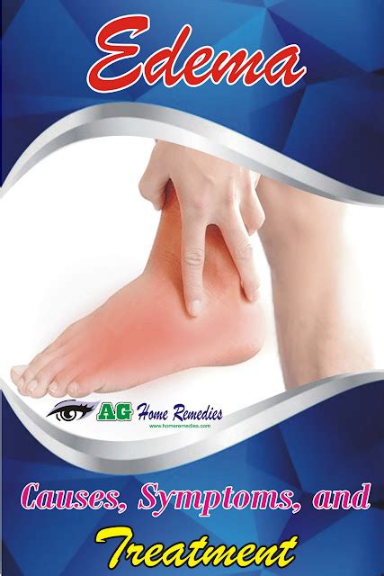 Edema Causes Symptoms And Treatment