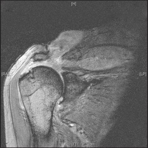 Mri Scan Showing A Large Glenohumeral Joint Effusion Wi Open I