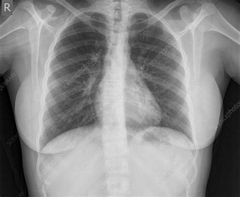 Normal Healthy Chest X Ray Stock Image C0197286 Science Photo
