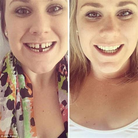 Brace Wearers Share Their Before And After Pictures Daily Mail Online