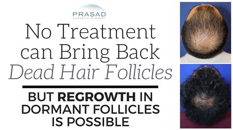 Do Damaged Hair Follicles Grow Back Quick Answer