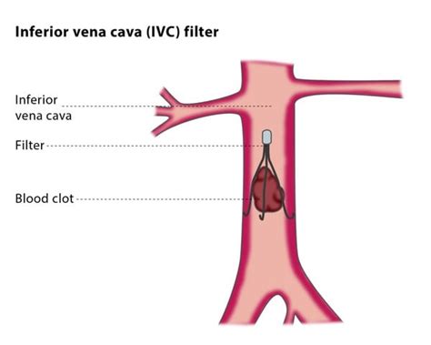 Inferior Vena Cava Ivc Filters Placement And Retrieval Cirse
