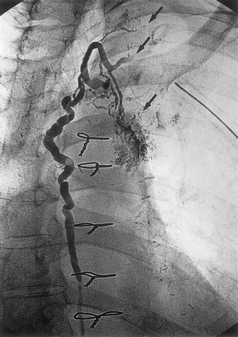 Percutaneous Embolization Of Thoracic Duct Injury Circulation