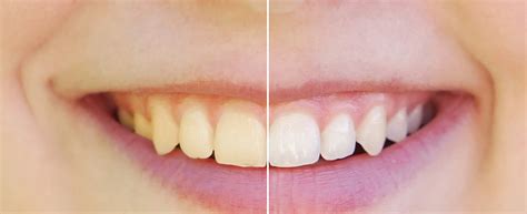 5 Benefits Of Whitening Teeth