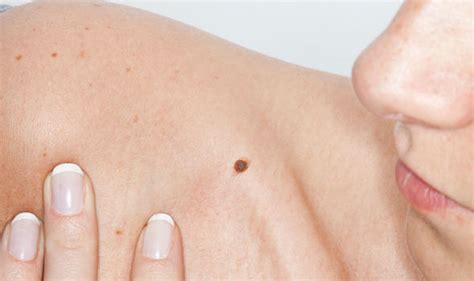 First Signs Of Skin Cancer Do The Abcde Checklist To Detect If Your