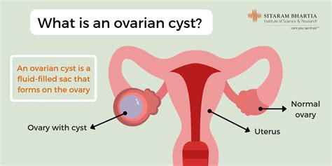 Pain Ovarian Cyst Size Chart Sexiz Pix