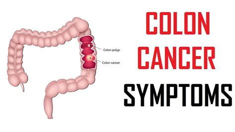 Warning Signs Of Colon Cancer Colon Cancer Symptoms Youtube