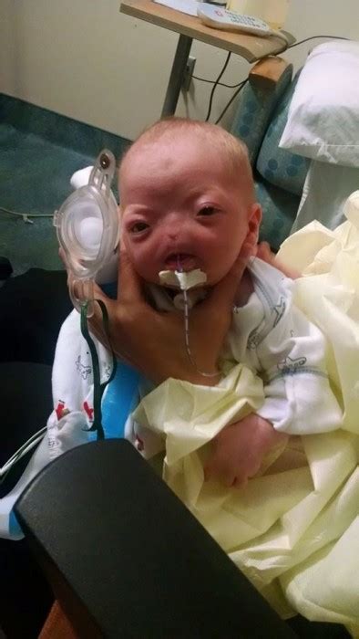 Parents Call Baby Born Without A Nose Perfect Live Action News