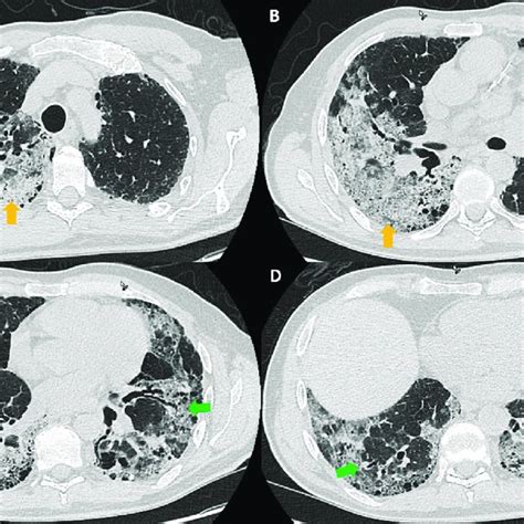 Computed Tomogram Of The Chest In Lung Windows Shows Honeycombing Red