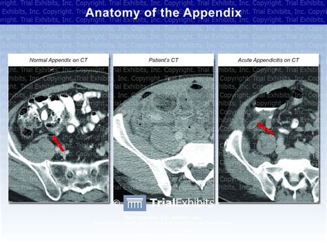Anatomy Of The Appendix Ct Scans Trial Exhibits Inc