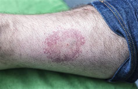 Lyme Disease Symptoms Causes And Treatment
