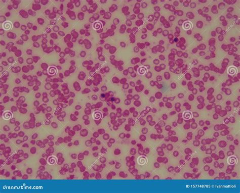 Sickle Cell Anemic Blood Under Microscope Red Blood Cells Stock Image