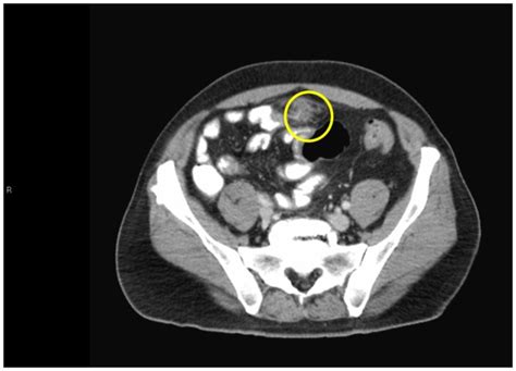 Ct Of Abdomen And Pelvis With Contrast Demonstrating A Small Area Of