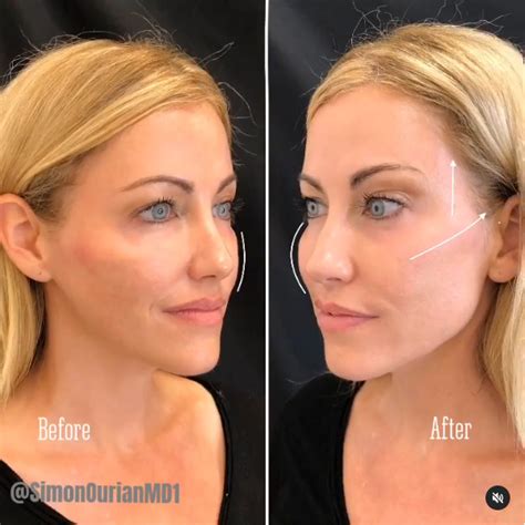 Cheek Contouring Before And After Photo Gallery Epione