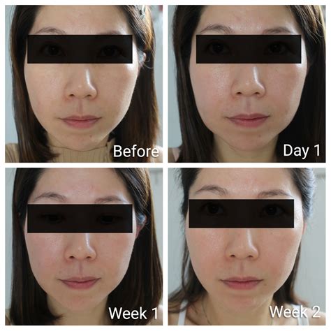 Ultherapy Results Before And After Photos Show Slimmer Face And Sharper