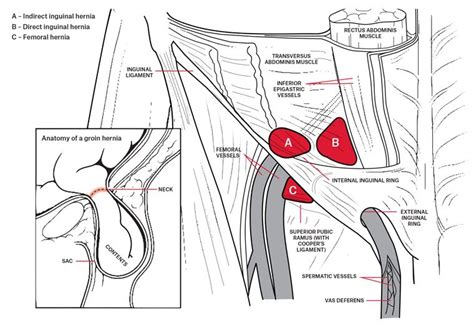 Unilateral Inguinal Hernia Causes Broken Curve