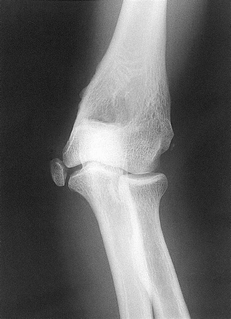 Postreduction Radiograph Showing Good Alignment Of The Elbow Joint And